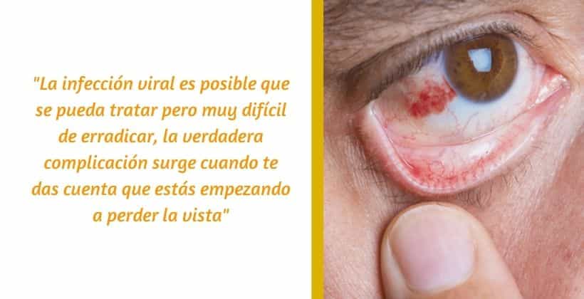 infecciones oculares por herpes